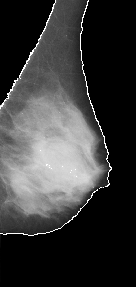 \includegraphics[width=3 cm]{images/breastsegmentation1.eps}
