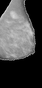 \includegraphics[width=3 cm]{images/breastsegmentation2.eps}
