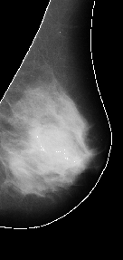 \includegraphics[width=3 cm]{images/breastsegmentation1bo.eps}