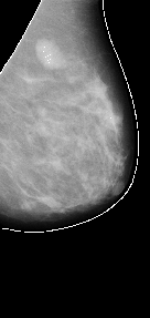 \includegraphics[width=3 cm]{images/breastsegmentation2bo.eps}